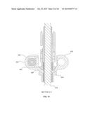 BONE TRANSPORT EXTERNAL FIXATION FRAME diagram and image