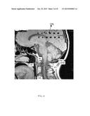 IMAGE GUIDED ATLAS CORRECTION diagram and image