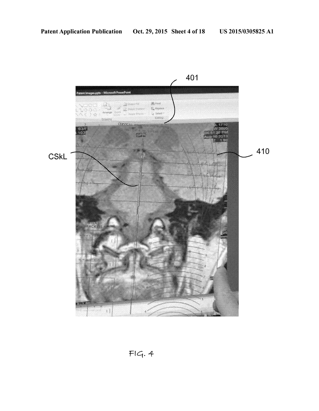 IMAGE GUIDED ATLAS CORRECTION - diagram, schematic, and image 05