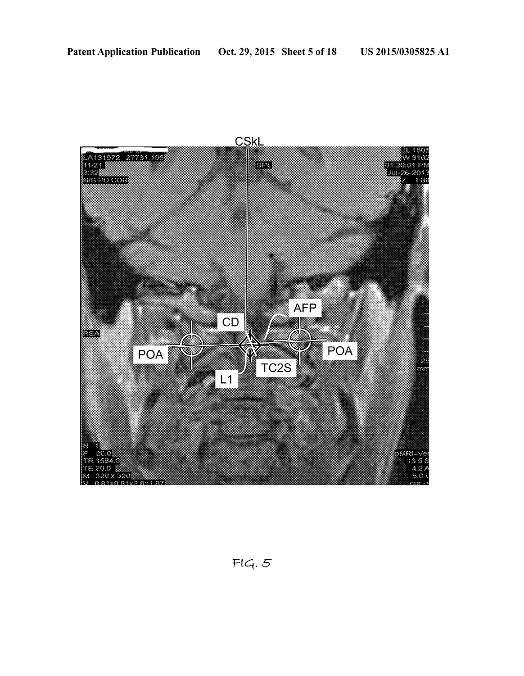 IMAGE GUIDED ATLAS CORRECTION - diagram, schematic, and image 06