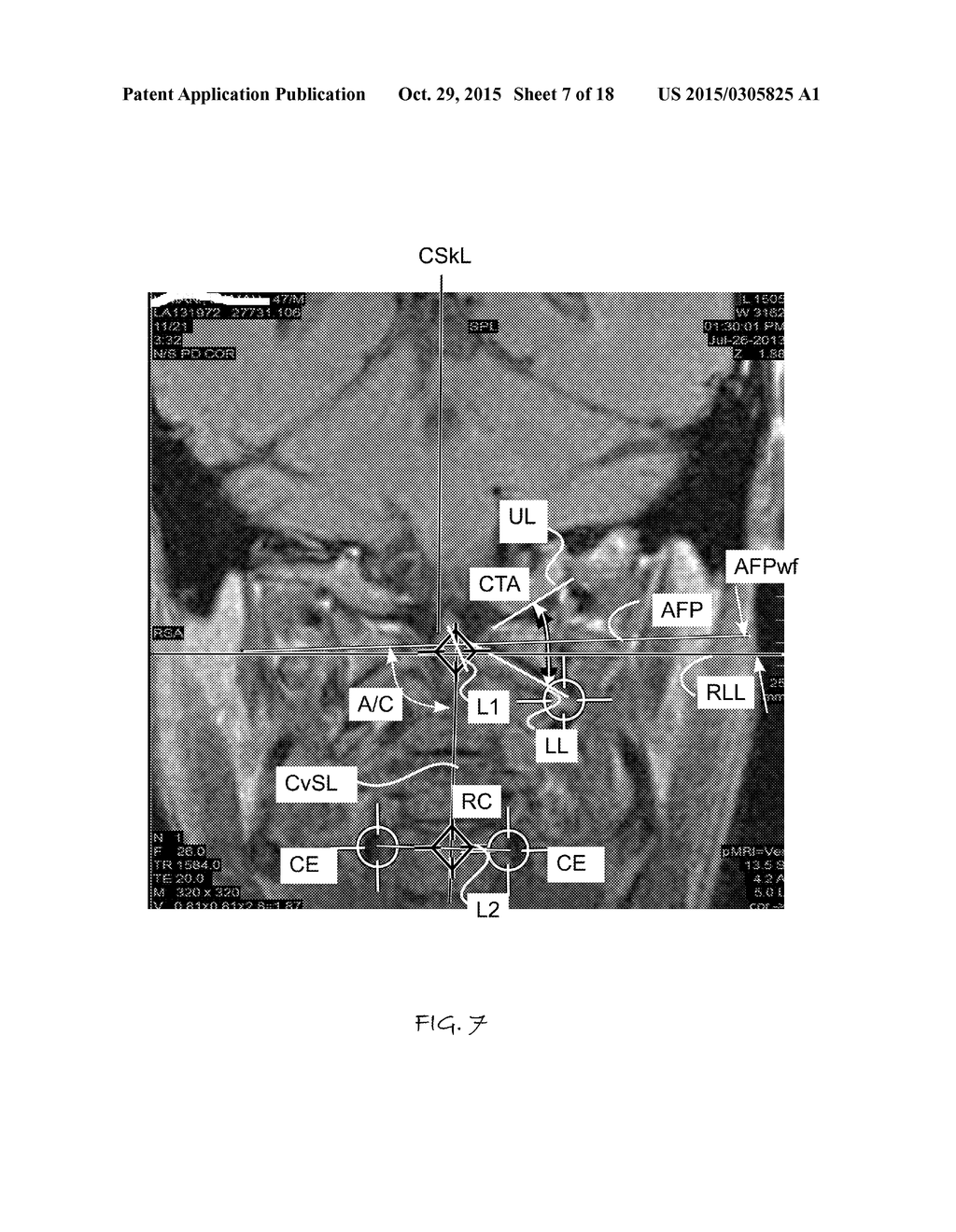 IMAGE GUIDED ATLAS CORRECTION - diagram, schematic, and image 08