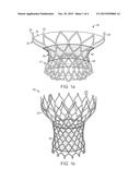 Paravalvular Leak Resistant Prosthetic Heart Valve System diagram and image