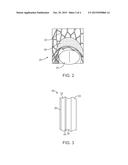 Paravalvular Leak Resistant Prosthetic Heart Valve System diagram and image