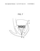 TRUNCATED CONE HEART VALVE STENT diagram and image