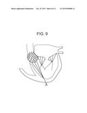 TRUNCATED CONE HEART VALVE STENT diagram and image