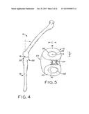 ANTERIOR CRUCIATE LIGAMENT SUBSTITUTING KNEE IMPLANTS diagram and image