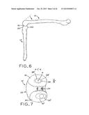 ANTERIOR CRUCIATE LIGAMENT SUBSTITUTING KNEE IMPLANTS diagram and image