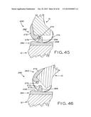 ANTERIOR CRUCIATE LIGAMENT SUBSTITUTING KNEE IMPLANTS diagram and image