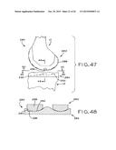 ANTERIOR CRUCIATE LIGAMENT SUBSTITUTING KNEE IMPLANTS diagram and image