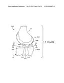 ANTERIOR CRUCIATE LIGAMENT SUBSTITUTING KNEE IMPLANTS diagram and image