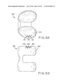 ANTERIOR CRUCIATE LIGAMENT SUBSTITUTING KNEE IMPLANTS diagram and image