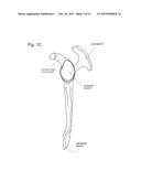 IMPLANTABLE GLENOID PROSTHESES diagram and image