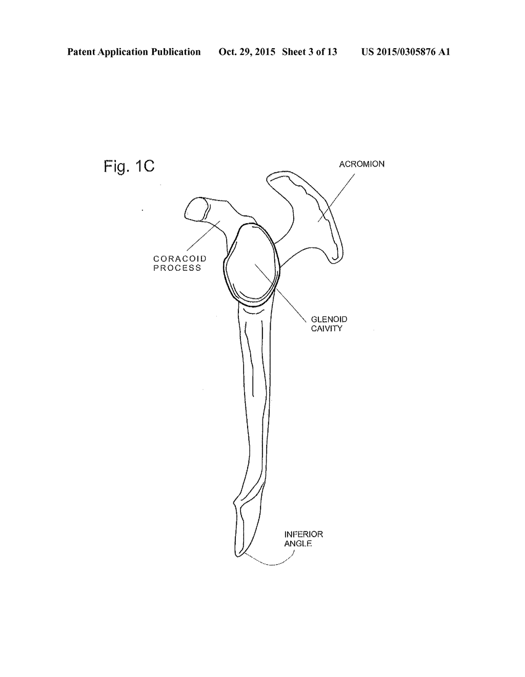 IMPLANTABLE GLENOID PROSTHESES - diagram, schematic, and image 04