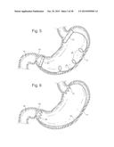 Bariatric Device and Method for Weight Loss diagram and image