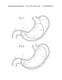 Bariatric Device and Method for Weight Loss diagram and image