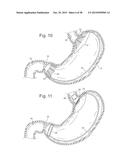 Bariatric Device and Method for Weight Loss diagram and image