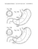 Bariatric Device and Method for Weight Loss diagram and image