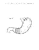 Bariatric Device and Method for Weight Loss diagram and image