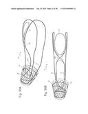 Bariatric Device and Method for Weight Loss diagram and image