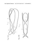 Bariatric Device and Method for Weight Loss diagram and image