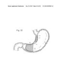 Bariatric Device and Method for Weight Loss diagram and image