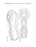 Bariatric Device and Method for Weight Loss diagram and image