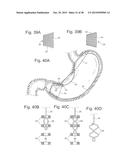 Bariatric Device and Method for Weight Loss diagram and image