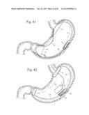 Bariatric Device and Method for Weight Loss diagram and image