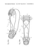 Bariatric Device and Method for Weight Loss diagram and image