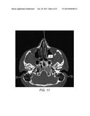 TREATMENT OF HEADACHE BY INJECTION OF NEUROINHIBITORY SUBSTANCE TO     SPHENOPALATINE GANGLION OR OTIC GANGLION diagram and image