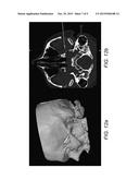 TREATMENT OF HEADACHE BY INJECTION OF NEUROINHIBITORY SUBSTANCE TO     SPHENOPALATINE GANGLION OR OTIC GANGLION diagram and image