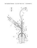 Catheter Guide and Method for Utilizing the Same diagram and image