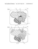 LOCATION OF FRAGMENTS DURING LITHOTRIPSY diagram and image