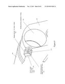 Stopper for the Cables of a Bending Section of An Endoscope diagram and image