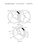 X-Ray Reduction System diagram and image