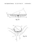 Occlusion Device diagram and image