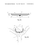 Occlusion Device diagram and image