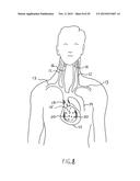 NONINVASIVE PROTECTION FROM EMBOLI diagram and image