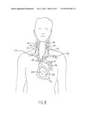 NONINVASIVE PROTECTION FROM EMBOLI diagram and image