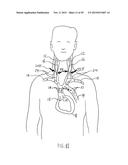 NONINVASIVE PROTECTION FROM EMBOLI diagram and image