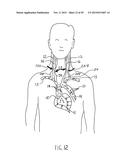 NONINVASIVE PROTECTION FROM EMBOLI diagram and image
