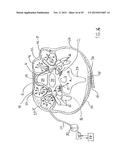 NONINVASIVE PROTECTION FROM EMBOLI diagram and image