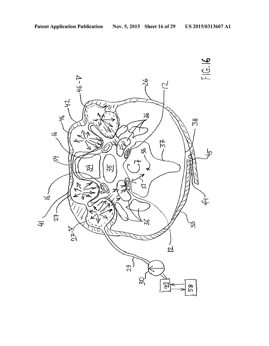 NONINVASIVE PROTECTION FROM EMBOLI - diagram, schematic, and image 17