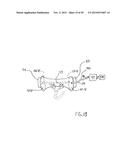 NONINVASIVE PROTECTION FROM EMBOLI diagram and image