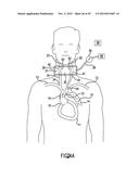 NONINVASIVE PROTECTION FROM EMBOLI diagram and image