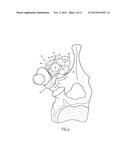 BONE FIXING SYSTEM AND METHOD OF USE diagram and image