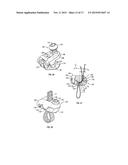 BONE FIXING SYSTEM AND METHOD OF USE diagram and image