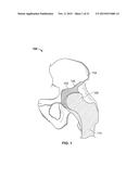 METHOD AND SYSTEM FOR ALIGNING A PROSTHESIS DURING SURGERY diagram and image