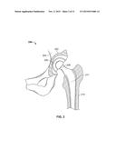 METHOD AND SYSTEM FOR ALIGNING A PROSTHESIS DURING SURGERY diagram and image