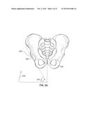 METHOD AND SYSTEM FOR ALIGNING A PROSTHESIS DURING SURGERY diagram and image